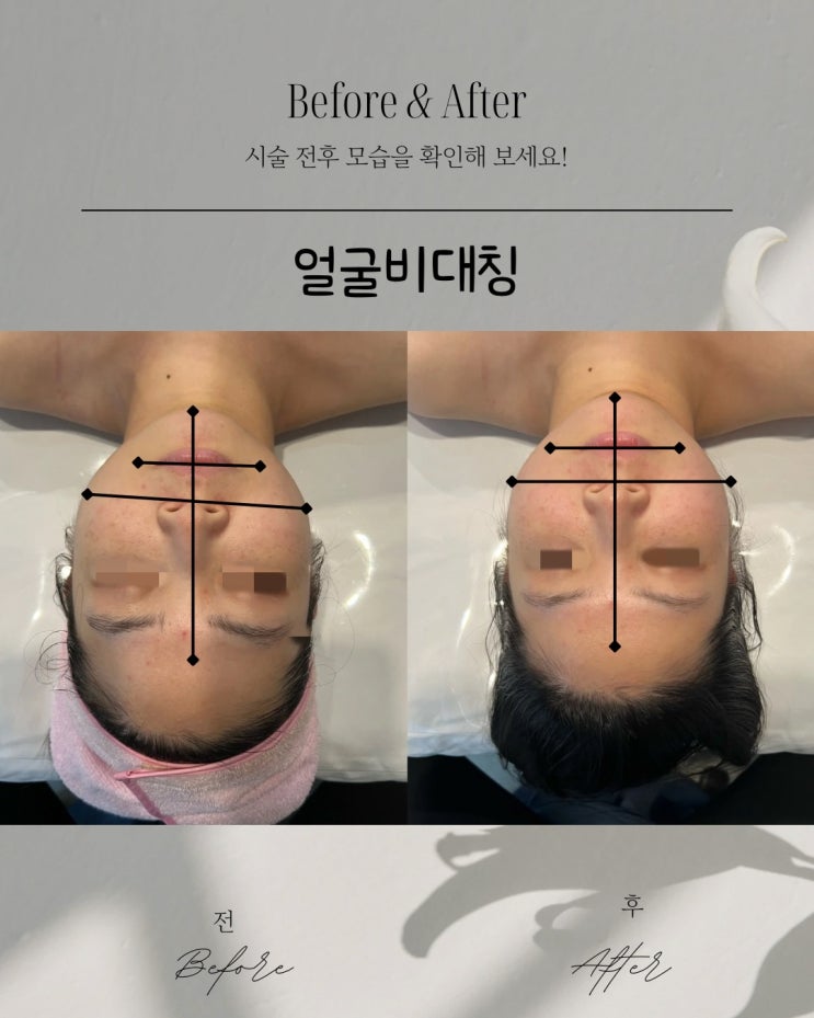  부산피부관리 얼굴비대칭, 그냥 둬도 괜찮을까요?