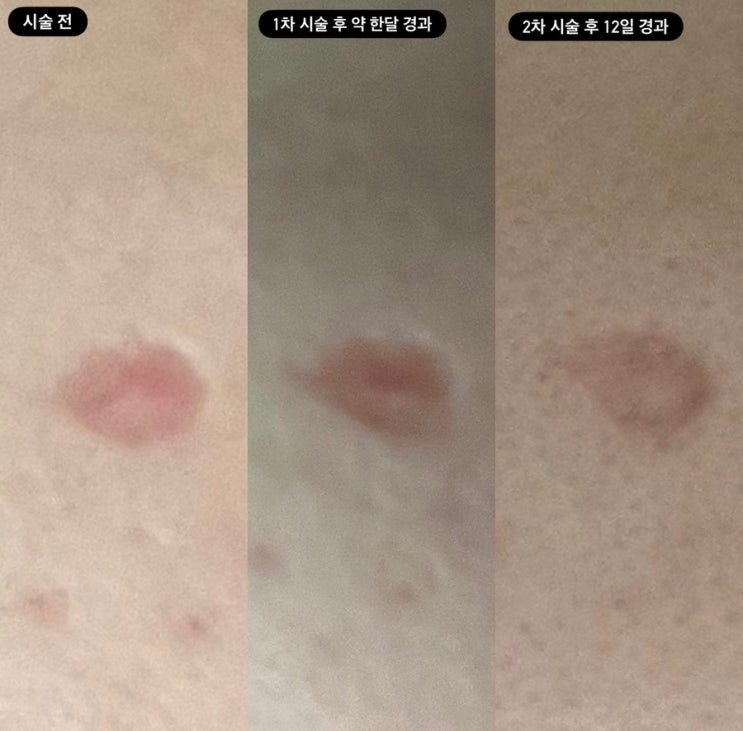  [흉터 치료] 새살침 패인흉터 내돈내산 솔직 후기(효과, 가격, 통증 등)
