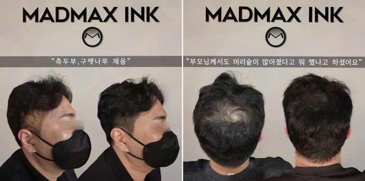  [매드맥스잉크] 천안두피커버로 자신감을 회복하는 법
