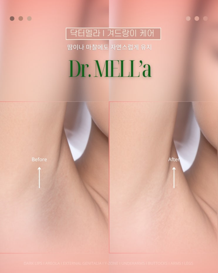  건대 멜라닌케어 1등 더세종뷰티 건대점 대만족 리뷰 닥터멜라