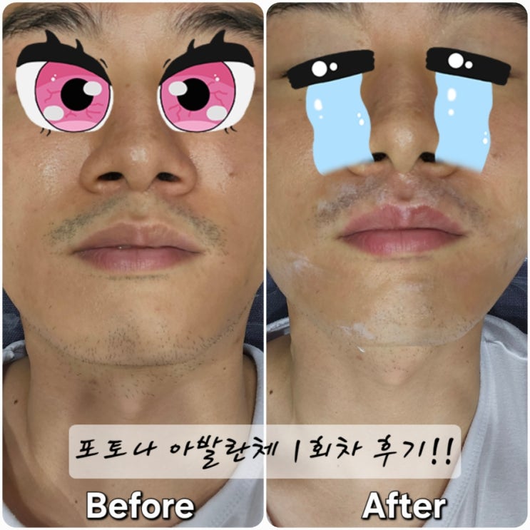  강남 / 신논현 피부과에서 최신 제모 기기 포토나 아발란체로 첫 제모했습니다!!