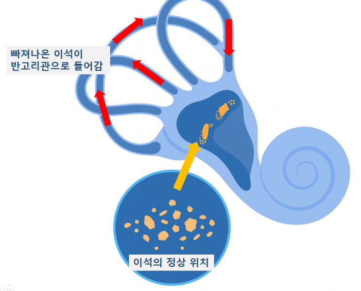  장위동 이석증, 갑자기 빙글빙글, 방치하면 반복됩니다