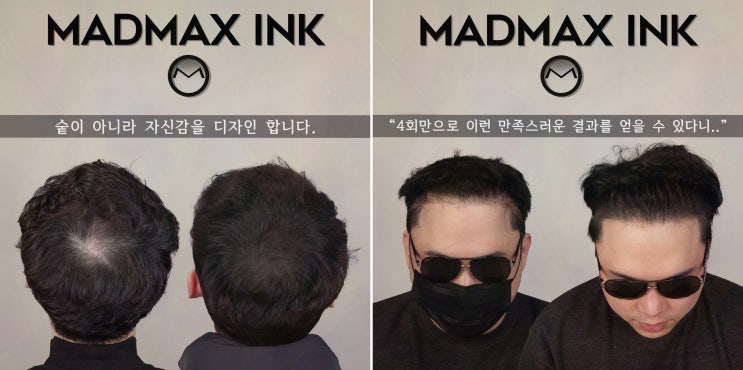  [매드맥스잉크] 천안탈모커버, 자연스럽고 세련된 인상 회복
