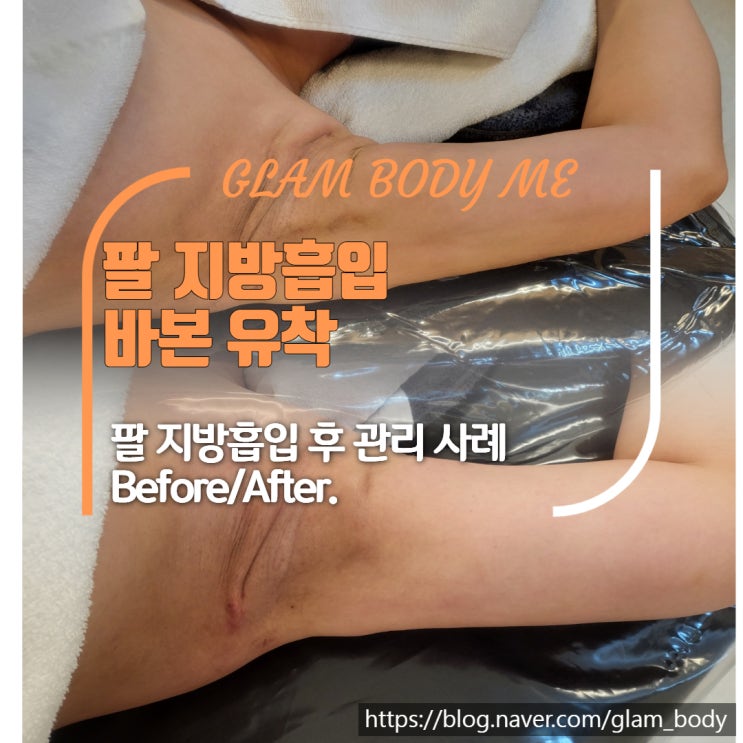  팔 지방흡입 후관리: 유착과 바본 (2주 차 - 5주 차) 비포 & 애프터