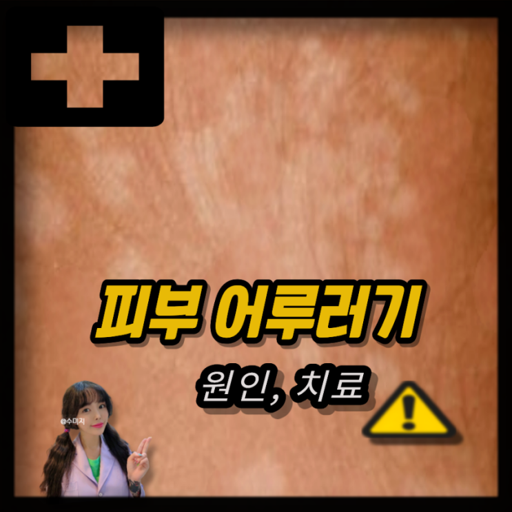 피부 어루러기 연고 겨드랑이 어루러기 원인 치료는?