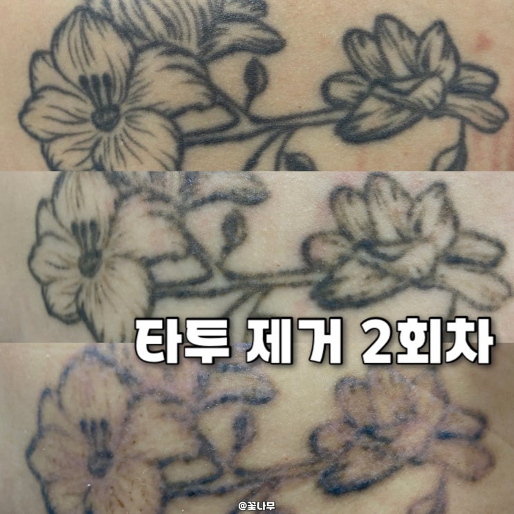  강남역피부과 타투 문신 제거 2회차 피코레이저 후기 과정 통증 전후 비교