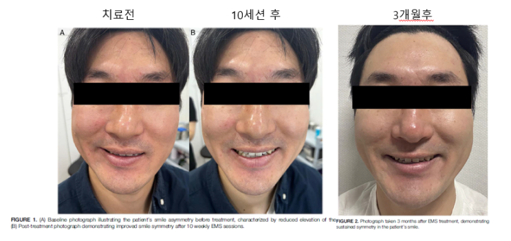  안면비대칭 교정, 중안면축소리프팅 이브타이탄 공식인증병원 효과 엠페이스와 가격비교 강남 아르네의원