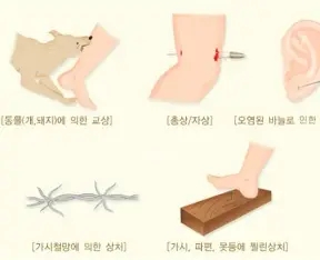 파상풍의 모든것 (진단, 증상,치료 후류증)