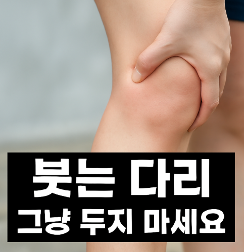 종아리 부종 다리 부종 붓는 이유 원인 약 부종에좋은 차 알아봐요