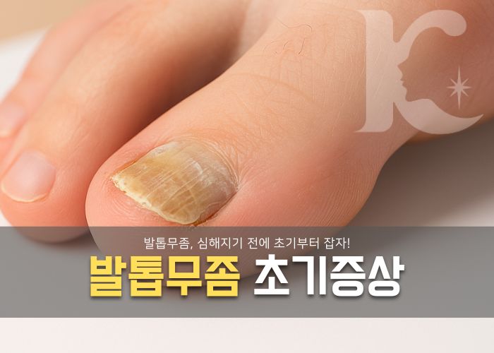  발톱무좀 초기 증상 알맞게 치료하려면 레이저로