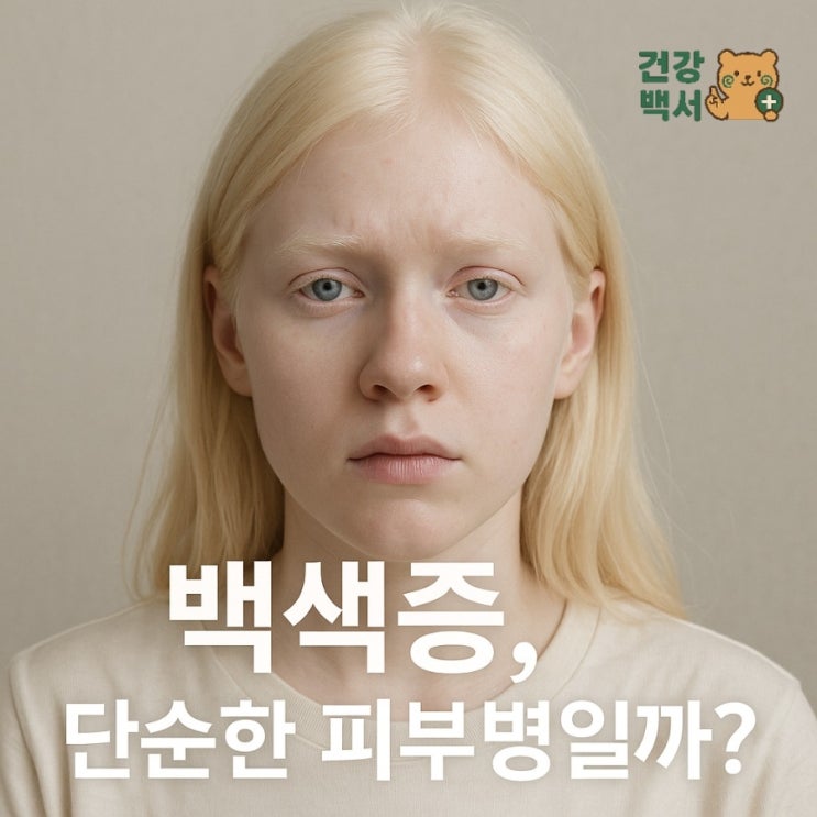  백색증, 단순한 피부병일까?