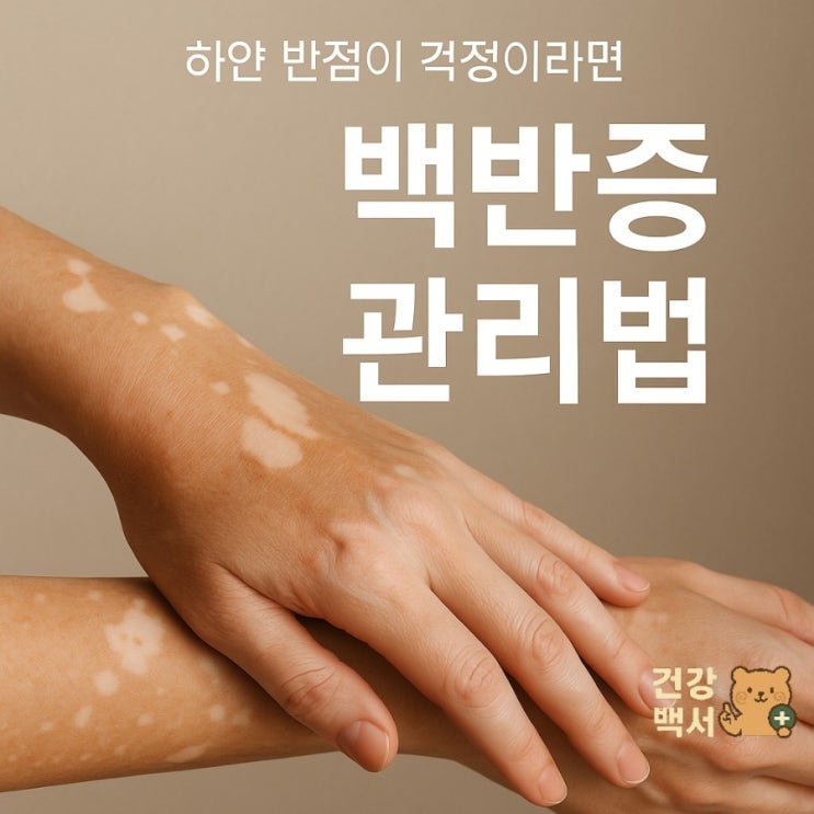  백반증 관리법, 후회 없이 시작해요