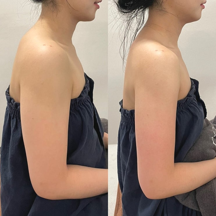  창원 팔뚝 관리 피부를가꾸다ㅣ데콜테 후 PPC앰플 수기 맛집