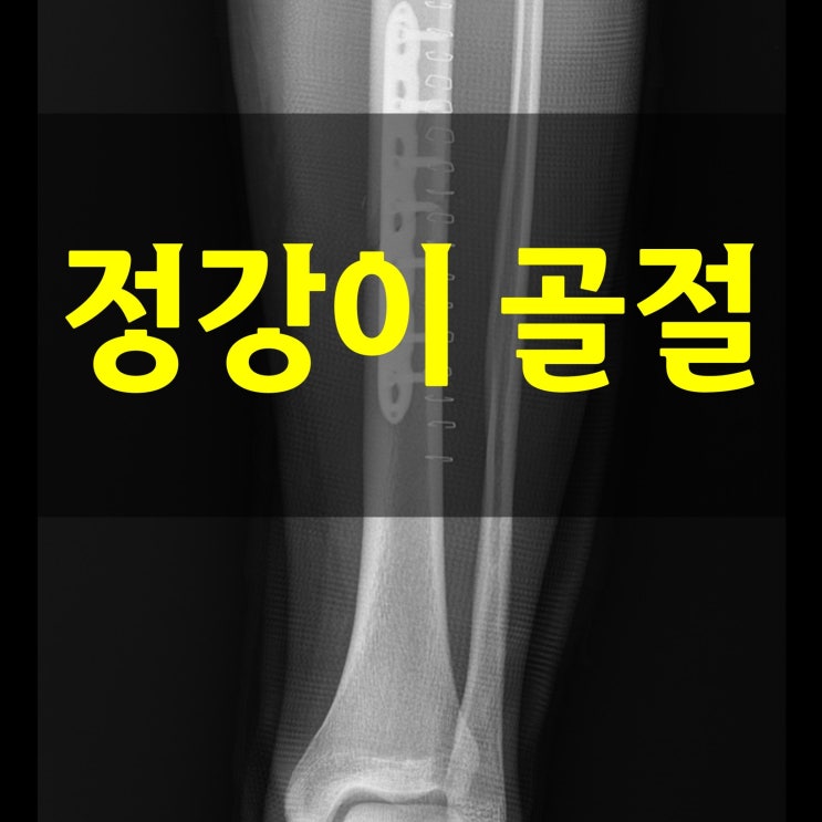  정강이 골절 환자 회복기간 피해야 할 것