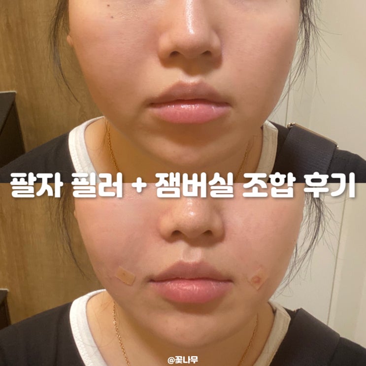  내돈내산 압구정로데오 피부과 필프팅 후기 팔자 주름 필러 실리프팅 잼버실 조합 효과와 통증
