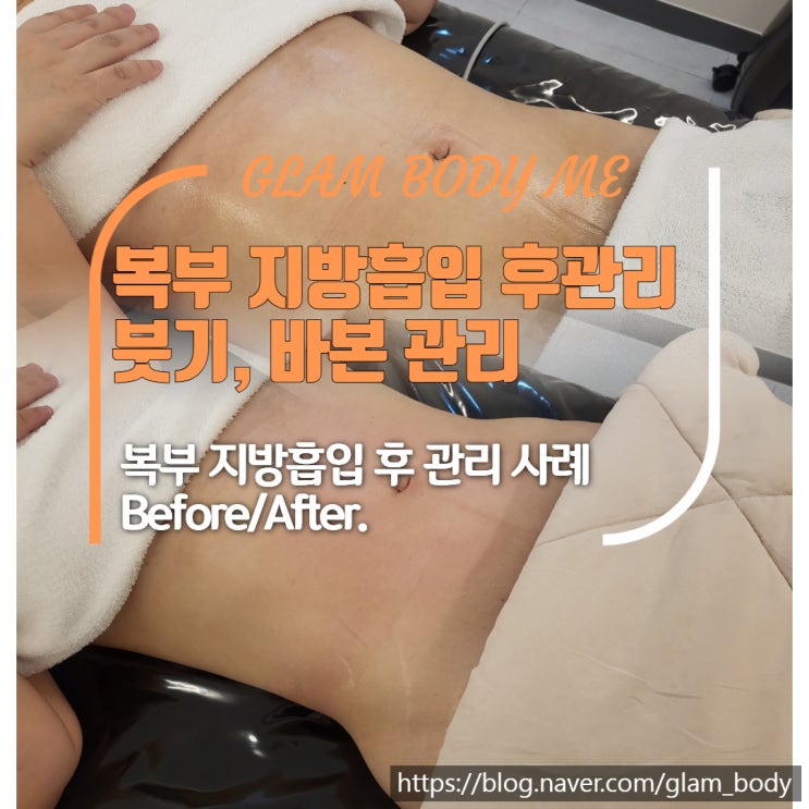  복부 지방흡입 후관리: 붓기,바본관리 (2주 차 - 5주 차) B&A