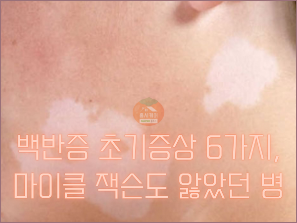 백반증 초기증상 6가지, 마이클 잭슨도 앓았던 병