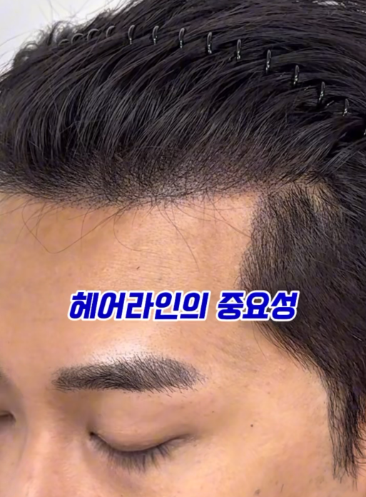  M자 탈모 커버 방법 없을까? 몽스칼프 솔루션