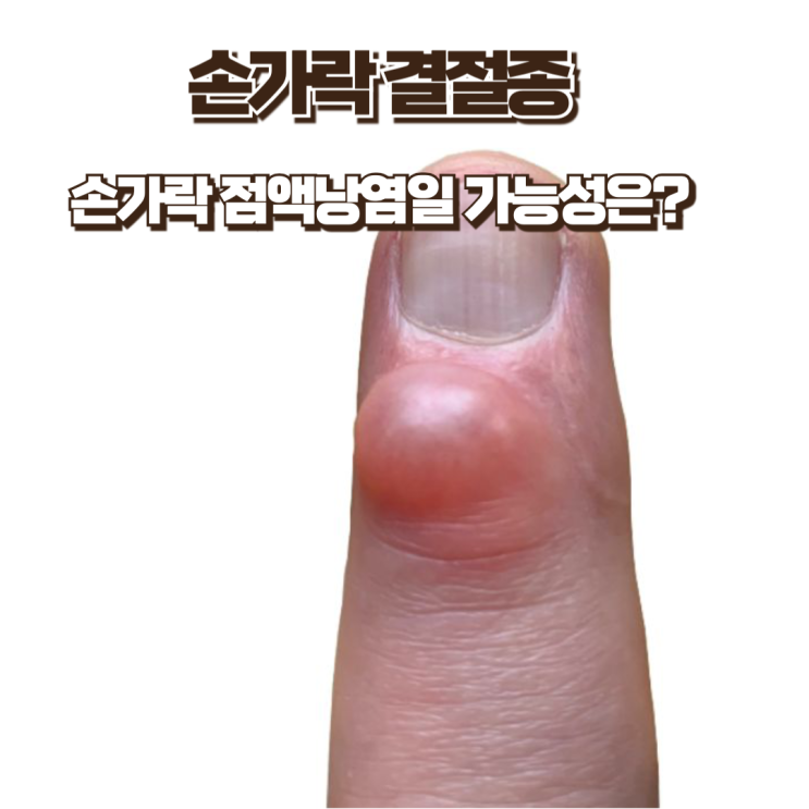  손가락에 혹이 생겼다면 어떤 질환일까? 손가락 결절종, 점액낭염?