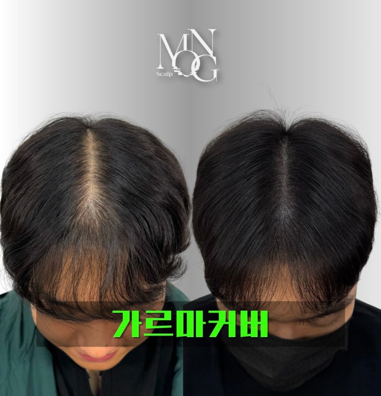  서울 강남 smp 남자 머리 탈모 커버 방법