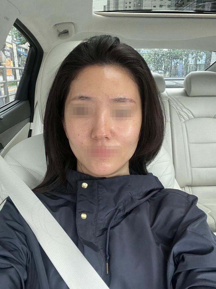  [에토좀PTT+제네시스 레이저] 5차 내돈내산 기록