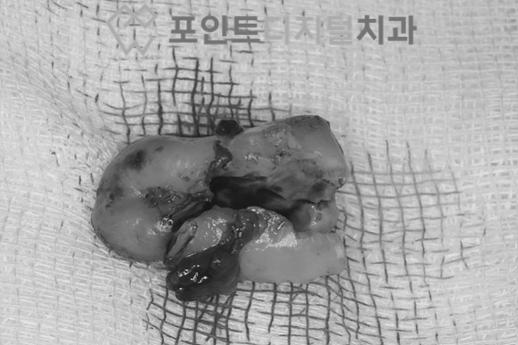 [탕정치과]  다른치과에서 발치가 힘들거 같다고 하셔서 내원하신 환자분(매복 사랑니 발치) / 천안 아산 불당 배방