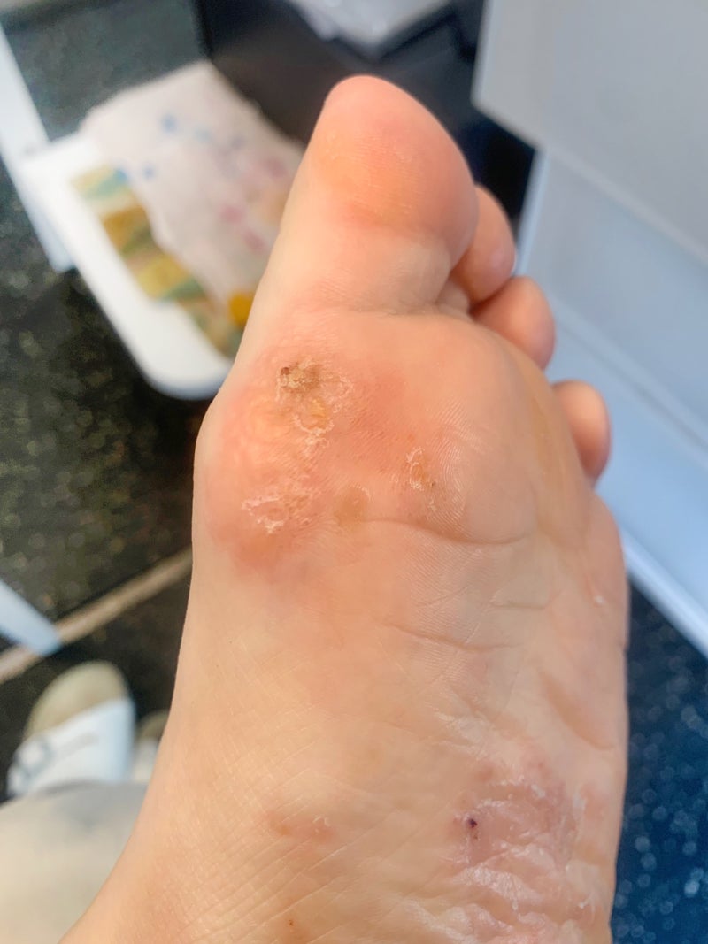 한포진 가려움 연고 비판텐 시카라놀린 사용 후기