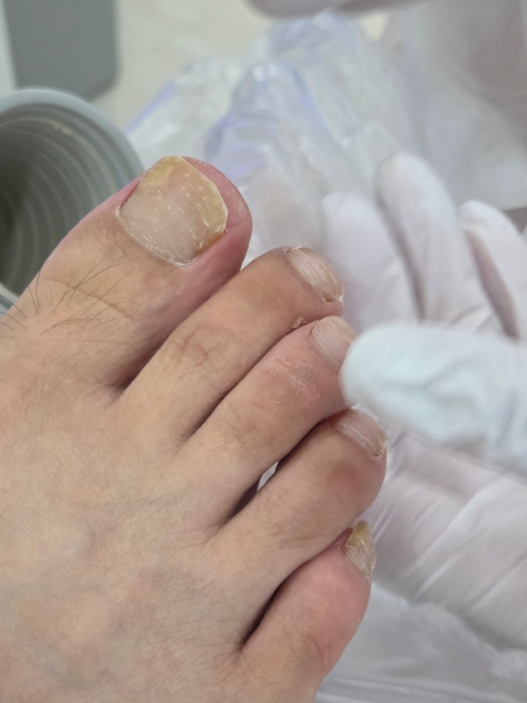  부산발관리 명지 함원장뷰티 (무좀발톱, 발각질관리, 내성발톱)