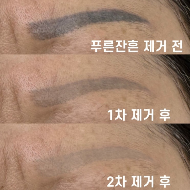  건대 눈썹문신 제거, 잔흔까지 깔끔하게! 가성비 좋게 없애려면?