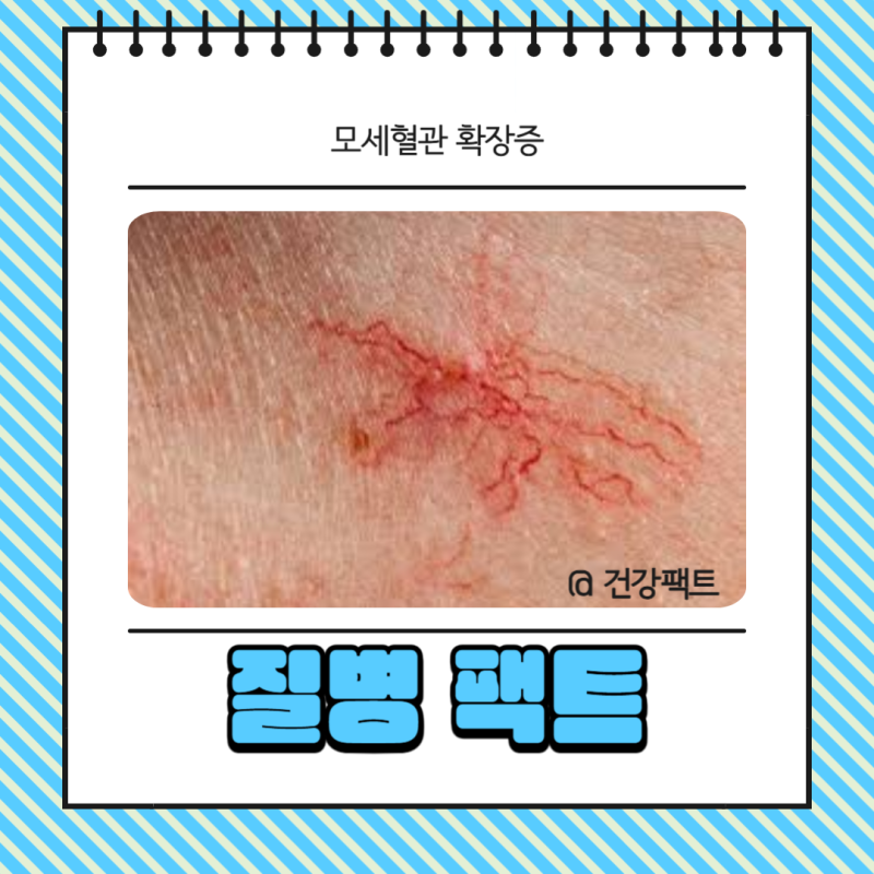 모세혈관 확장증 얼굴 다리 치료 방법 총정리
