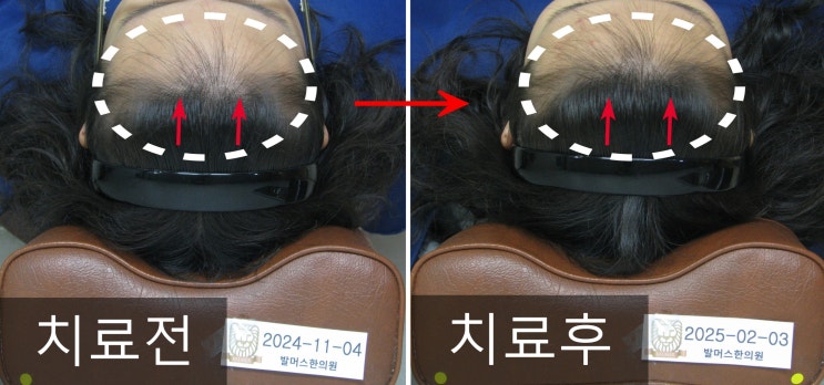  약해진 모발과 앞머리 탈모, 약침으로 얼만큼 좋아질 수 있을까? _ 홍대 발머스 한의원 20대 여성의 사례