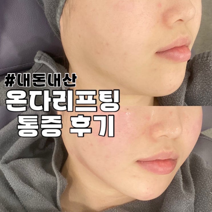  대구 동성로 반월당역 피부과 통증 없이 중안부 줄이기 온다리프팅 내돈내산 후기