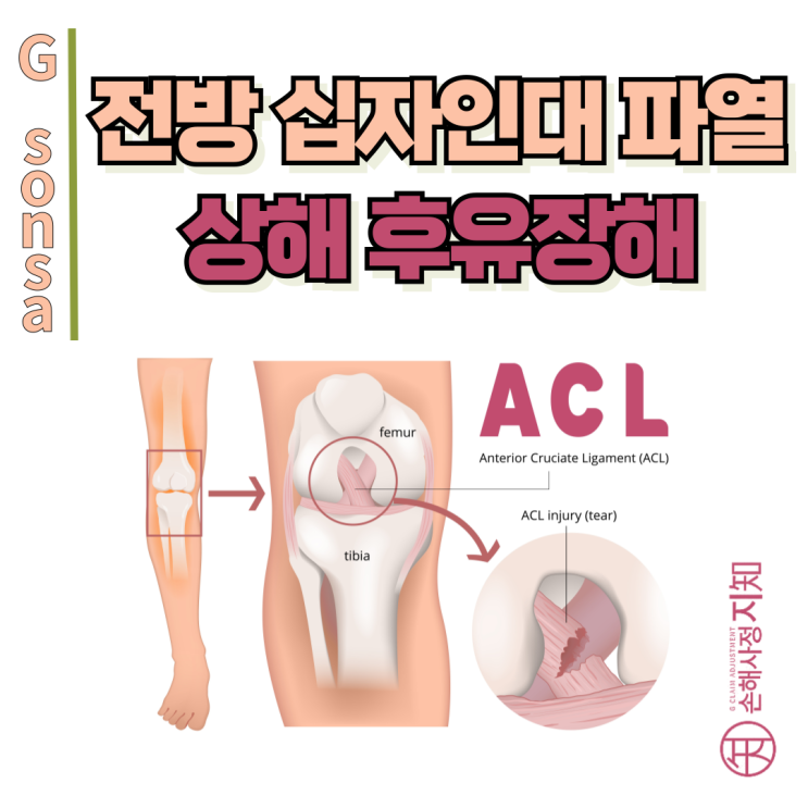  전방 십자인대 파열 재활, 끝난 게 아니라 상해후유장해 청구 시작입니다. - [보험금, BA+DA]