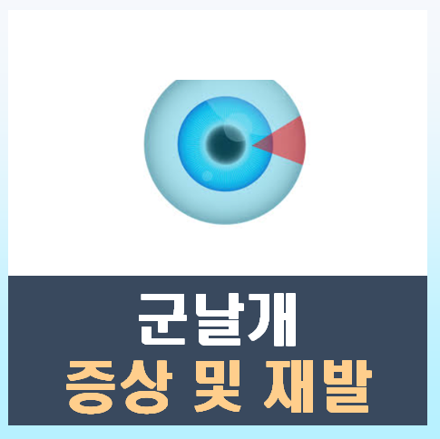 군날개 증상과 재발: 안과 전문의가 알려주는 예방과 치료 전략