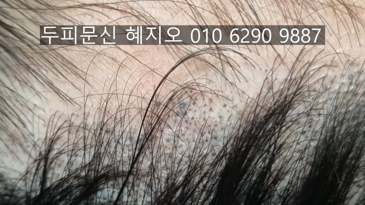  인천 청라 두피페인팅 부작용 색소번짐 원인 및 해결방법
