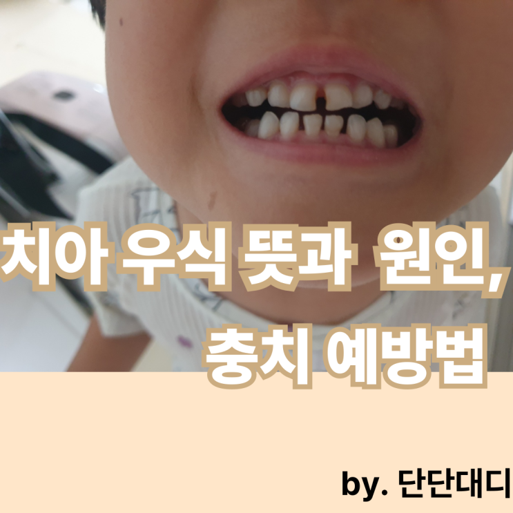  단단대디가 소개하는 치아 우식 뜻과 원인, 충치 예방법
