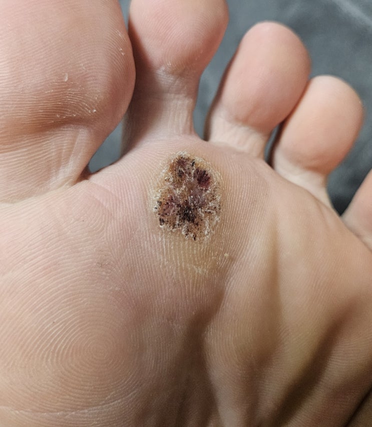  발바닥 사마귀 치료, 이번 주도 잘 다녀왔어요! (토요일 치료 + 월요일 경과 확인 후기)
