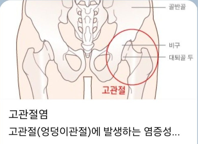 엉덩이 관절 연골이 닳거나 손상되어 염증과 통증을 일으키는(고관절염)