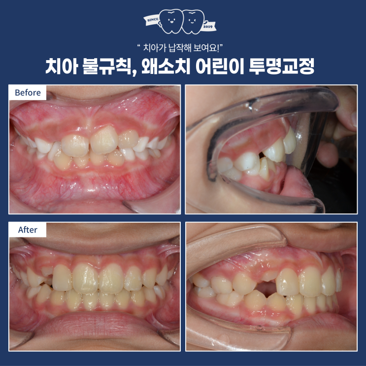  어린이 투명교정, 치아가 틀어져 보이고 왜소치가 있어도 해결 가능해요! 하남 투명교정