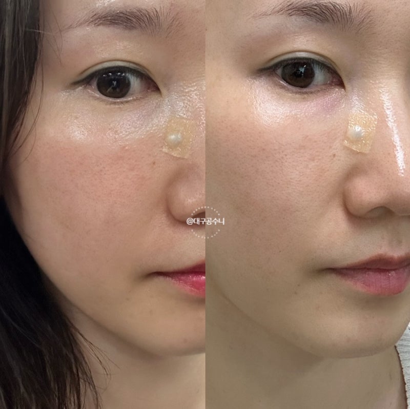 피부과 백옥주사(=글루타치온) 맞고 옴.. 효과 성분 가격 주기 부작용 전후 후기 있음!
