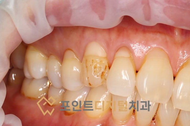  [탕정치과]  법랑질 형성부전치아 크라운대신 레진으로 치료하기 / 천안 아산