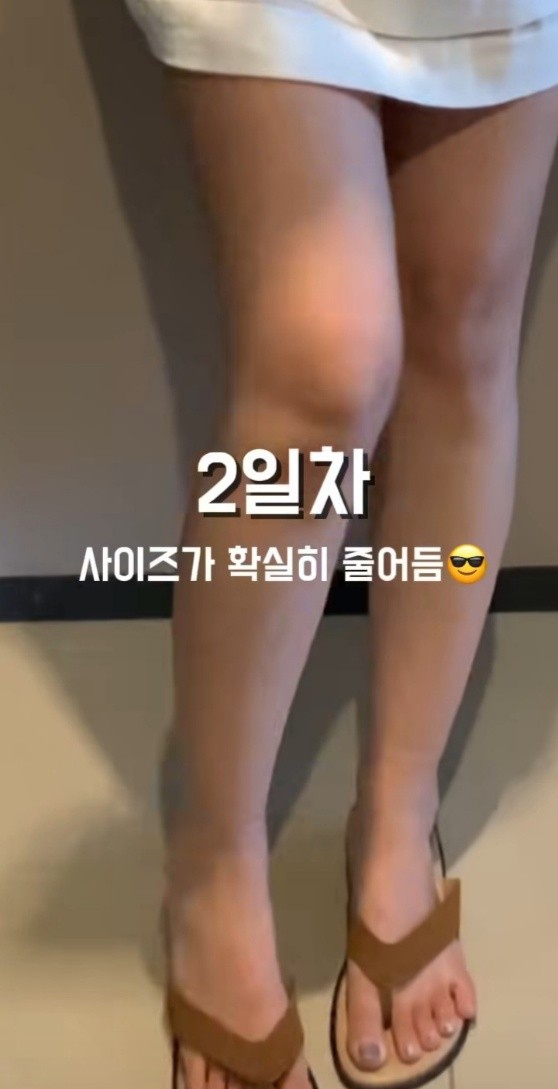  확실히 슬림해진 종아리 지방분해주사 카티주사 1회차 내돈내산 라라플랜