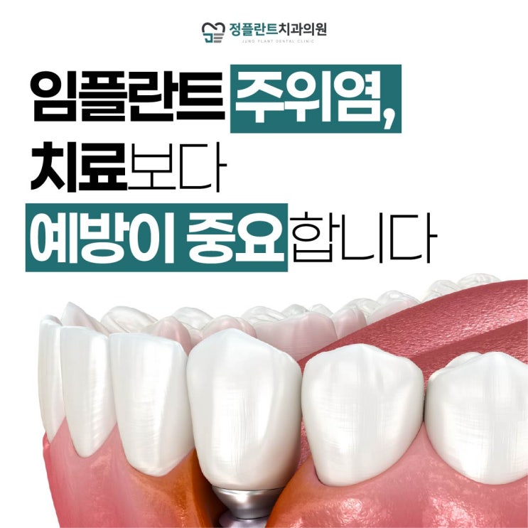  임플란트 주위염, 치료보다 예방이 중요한 이유