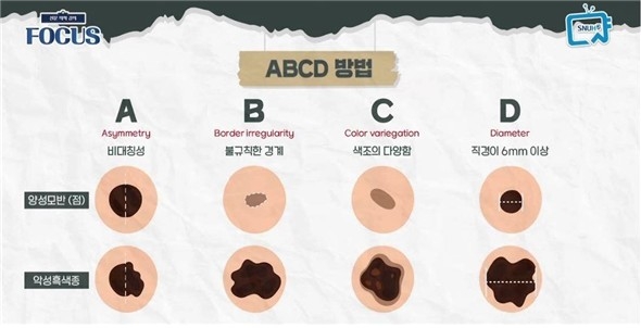 [위클리 건강] '점'인 줄 알았는데 '암'…알아두면 좋은 피부암 'ABCD룰'