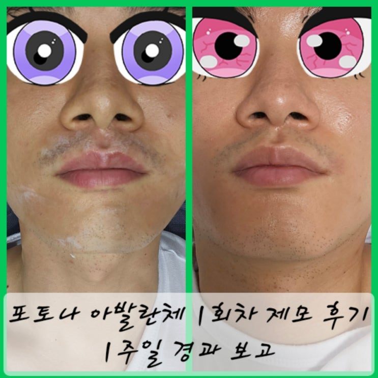  포토나 아발란체 제모 1회차, 1주일 경과 후기 보고드립니닷!