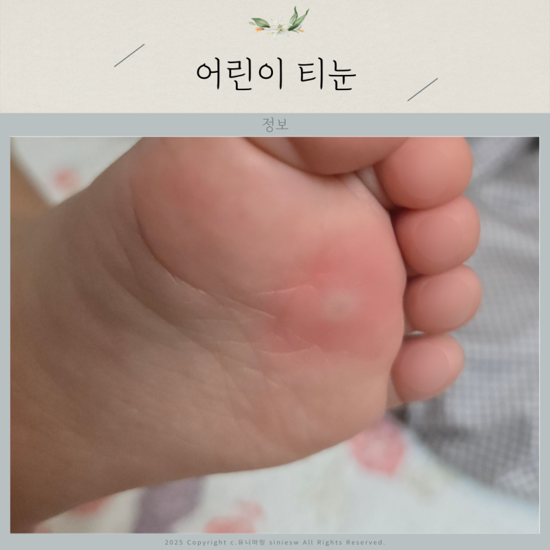 어린이 티눈 아기 발바닥 딱딱하게 굳은살 원인 사마귀 차이