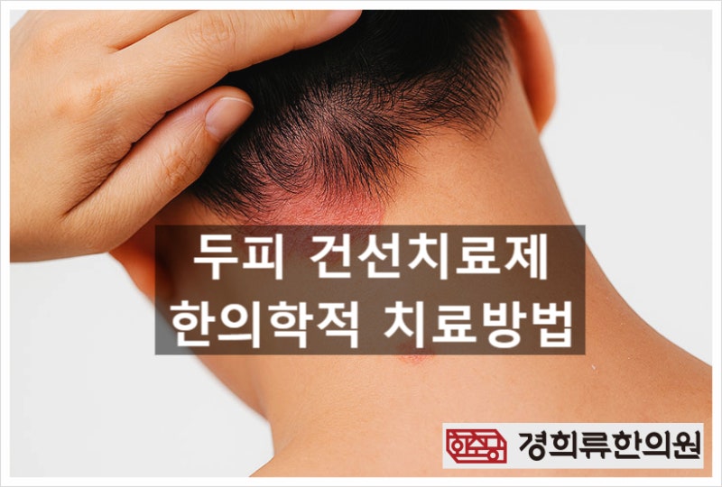 두피 건선치료제? 정확히 알아야 합니다(한의사 칼럼)