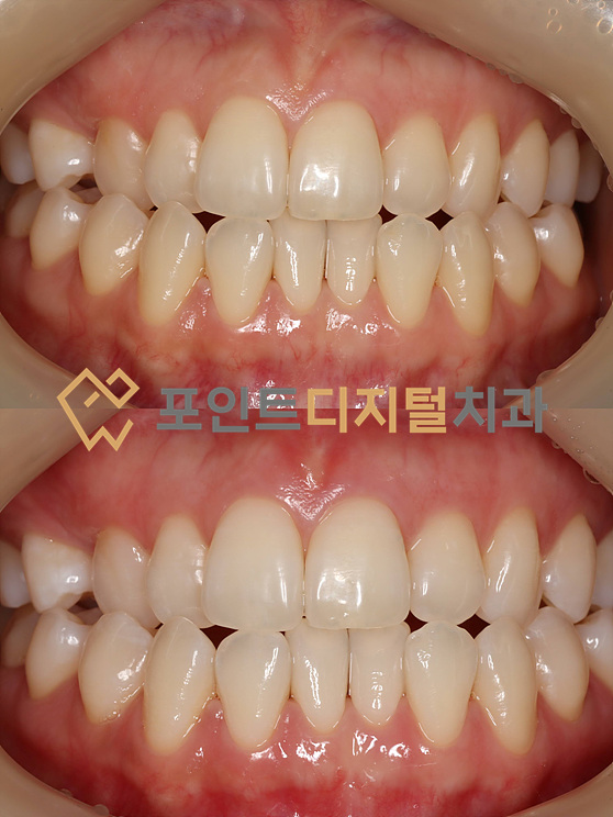  [탕정치과]  뷰티스 원데이 치아미백 ChatGPT에게 분석을 맡겨보았습니다 / 천안 아산 불당 배방