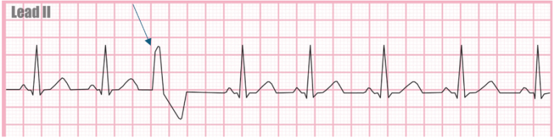 139) 심전도: VPC(Ventricular Premature Complex, PVC) 조기 심실 수축 + Bigeminy ...