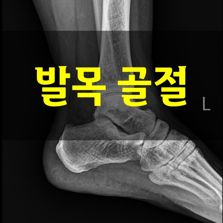  발목 골절 치료, 뼈가 늦게 붙는 지연유합이라면?